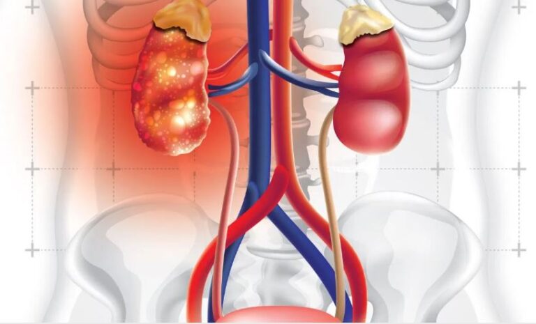 यी ६ संकेतलाई नगर्नुहोस् बेवास्ता, मिर्गौला बिग्रिन थालेको चेतावनी हुन सक्छ !